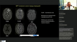 Разбор клинического случая локального роста анапластической глиомы головного мозга после хир. леч.